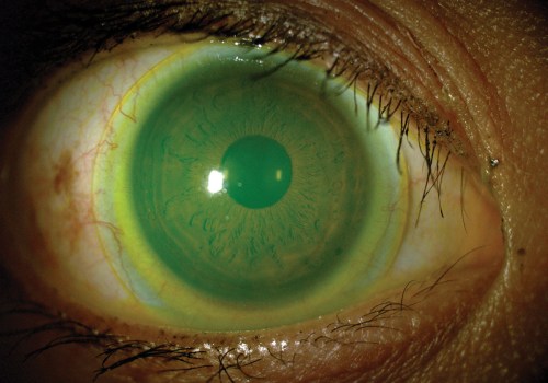Can Optometrists Provide Specialty Services Such as Scleral Lens Fitting?